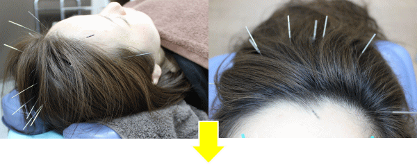 頭皮美鍼の施術写真